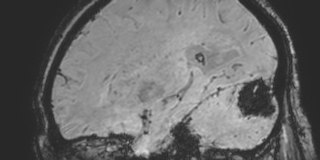 File:Cavernous hemangioma of the cerebellar falx (Radiopaedia 73025-83724 Sagittal BOLD 67).jpg