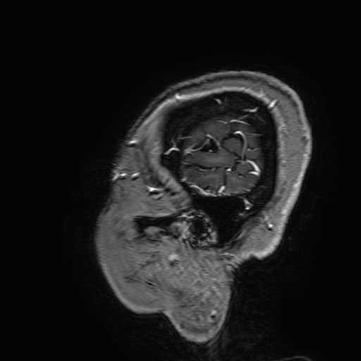 Cavernous hemangioma of the cerebellar falx (Radiopaedia 73025-83724 Sagittal T1 C+ 196).jpg