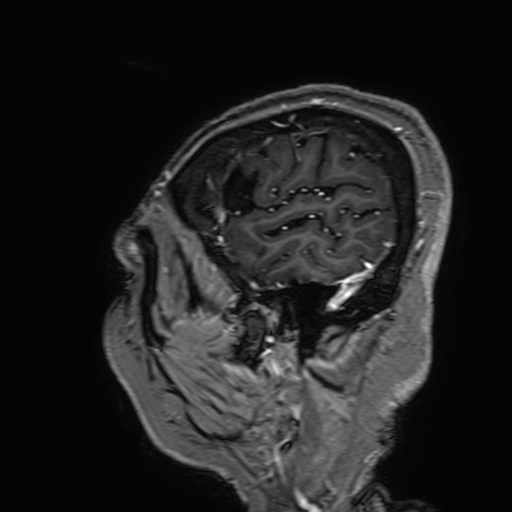 Cavernous hemangioma of the cerebellar falx (Radiopaedia 73025-83724 Sagittal T1 C+ 26).jpg