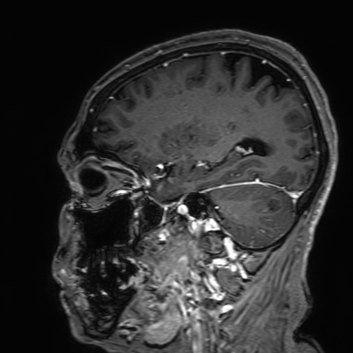 Cavernous hemangioma of the cerebellar falx (Radiopaedia 73025-83724 Sagittal T1 C+ 67).jpg