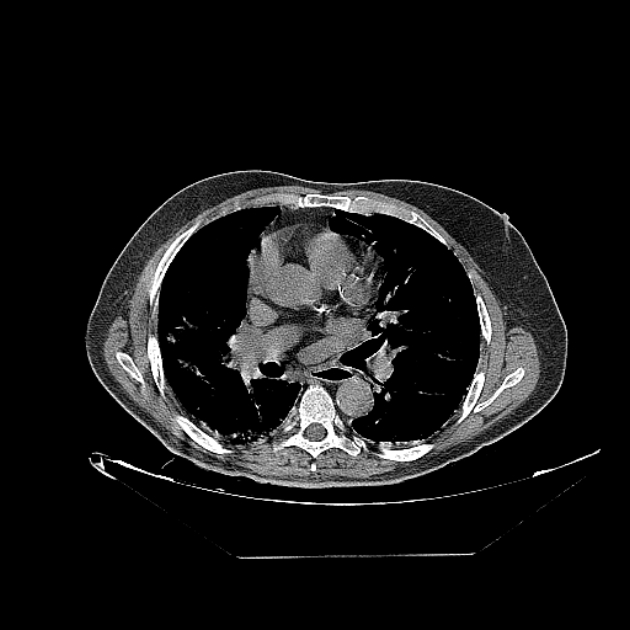 Cavitating bronchogenic carcinoma (Radiopaedia 44489-48162 Axial non-contrast 43).jpg