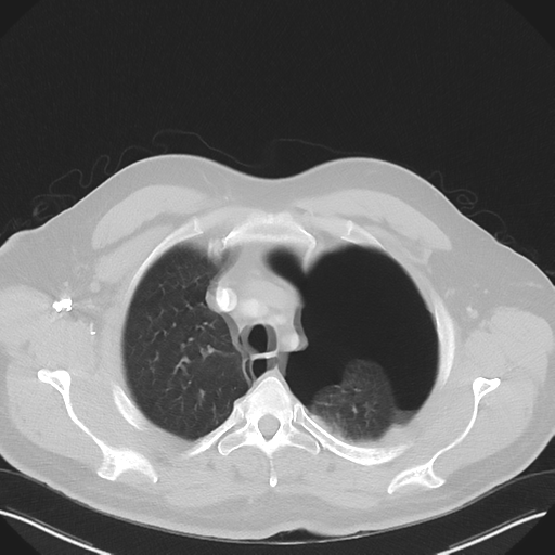 Cavitating pneumonia complicated by pneumothorax (Radiopaedia 48149-52994 Axial lung window 14).png