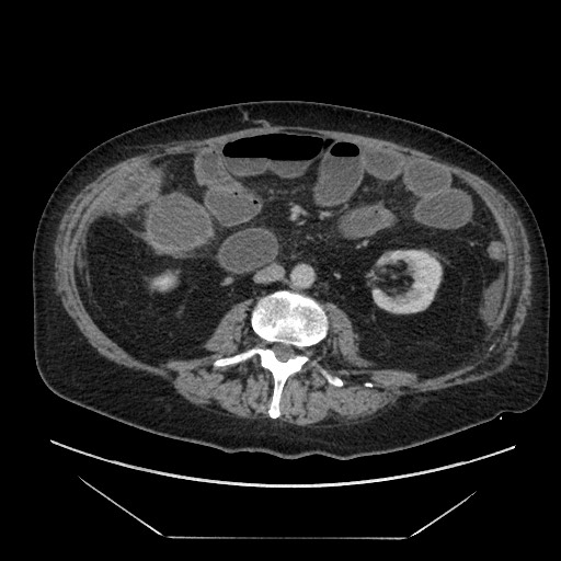 Cecal adenocarcinoma (Radiopaedia 64871-73817 A 50).jpg