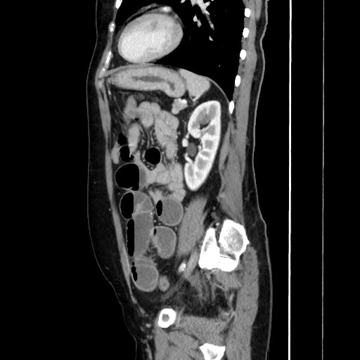 Cecal adenocarcinoma (Radiopaedia 75909-87331 C 49).jpg