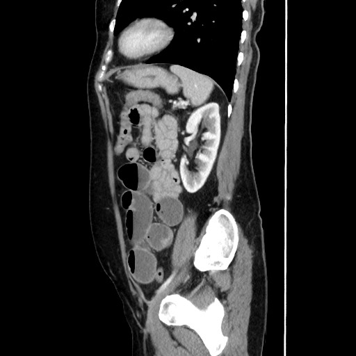 Cecal adenocarcinoma (Radiopaedia 75909-87331 C 51).jpg