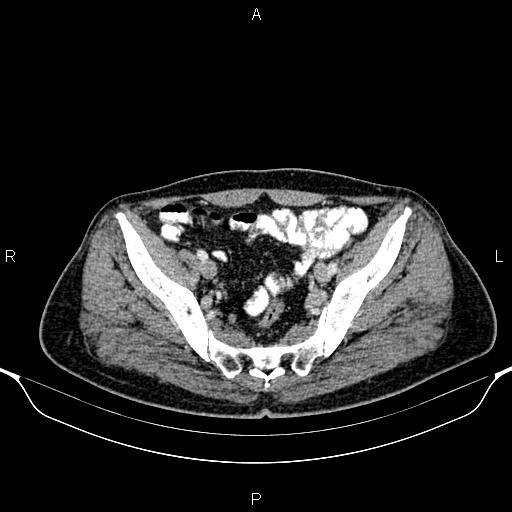 Cecal adenocarcinoma (Radiopaedia 85324-100916 B 81).jpg