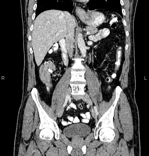 Cecal adenocarcinoma (Radiopaedia 85324-100916 D 34).jpg