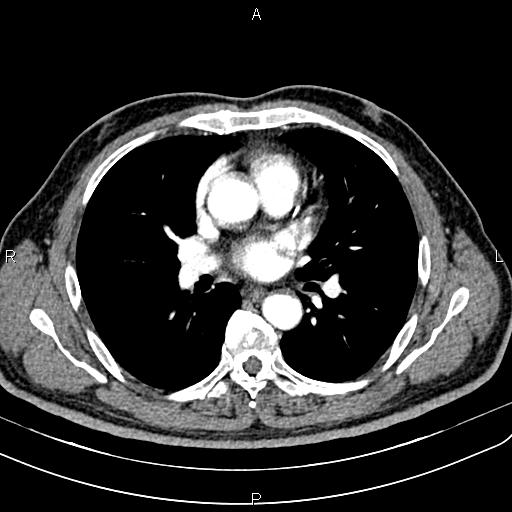 File:Cecal cancer with appendiceal mucocele (Radiopaedia 91080-108651 A 34).jpg