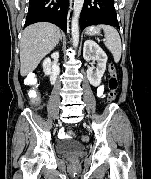 File:Cecal cancer with appendiceal mucocele (Radiopaedia 91080-108651 D 47).jpg