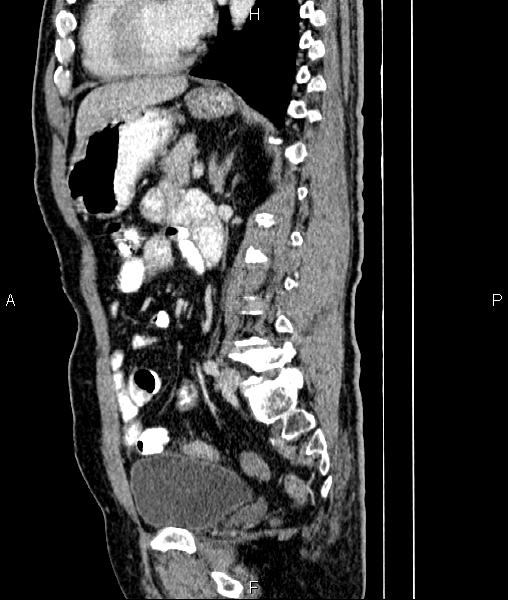 File:Cecal cancer with appendiceal mucocele (Radiopaedia 91080-108651 E 59).jpg