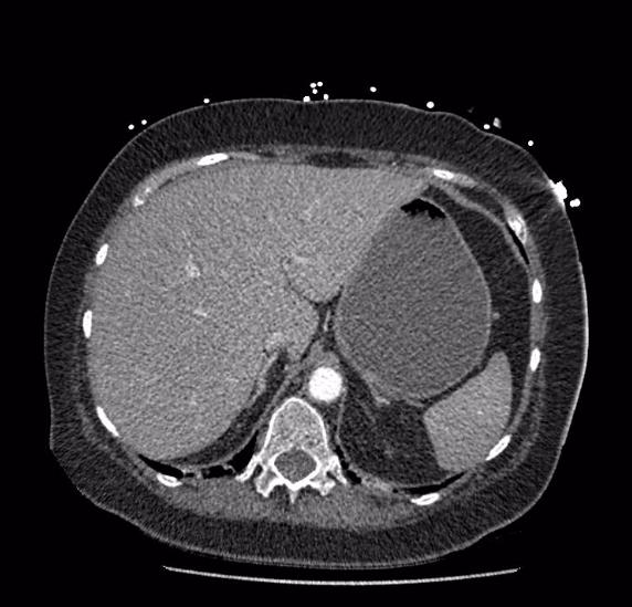 Celiac artery severe stenosis and dissection (Radiopaedia 44128-47842 B 15).jpg