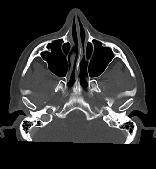 Cemento-ossifying fibroma (Radiopaedia 46243-50643 Axial bone window 25).png