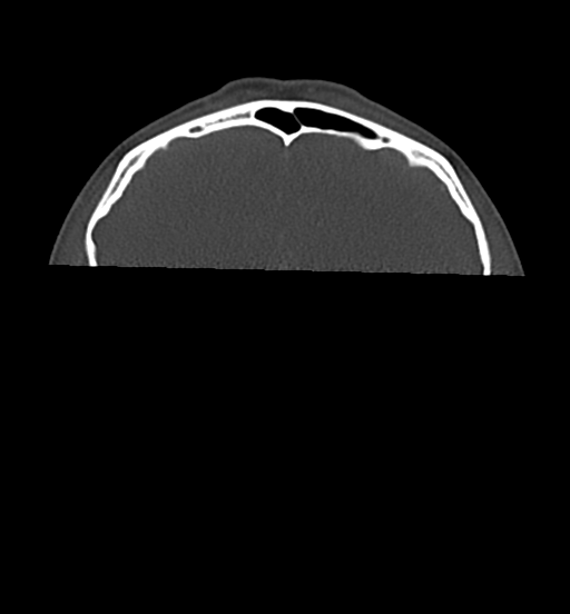 Cemento-ossifying fibroma (Radiopaedia 46243-50643 Axial bone window 9).png