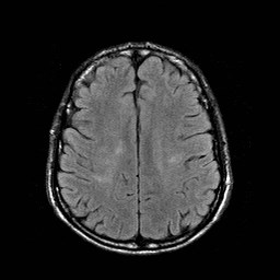 File:Central-variant posterior reversible encephalopathy syndrome (PRES) (Radiopaedia 43880-47358 Axial FLAIR 17).jpg