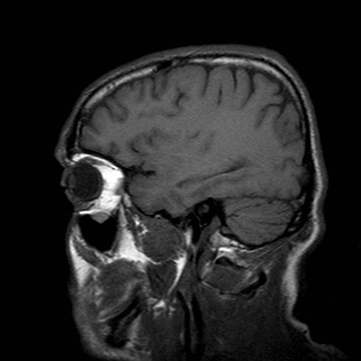 File:Central-variant posterior reversible encephalopathy syndrome (PRES) (Radiopaedia 43880-47359 Sagittal T1 18).jpg