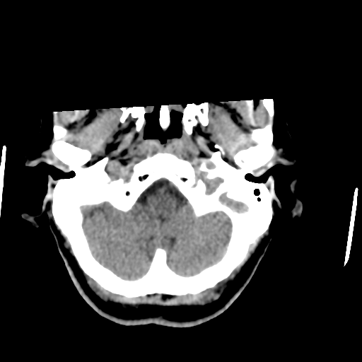 File:Central neurocytoma (Radiopaedia 65317-74346 Axial non-contrast 8).png