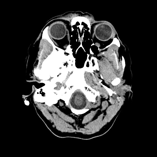 File:Central neurocytoma (Radiopaedia 68725-78432 Axial non-contrast 4).jpg