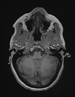 Central neurocytoma (Radiopaedia 84497-99872 Axial T1 48).jpg