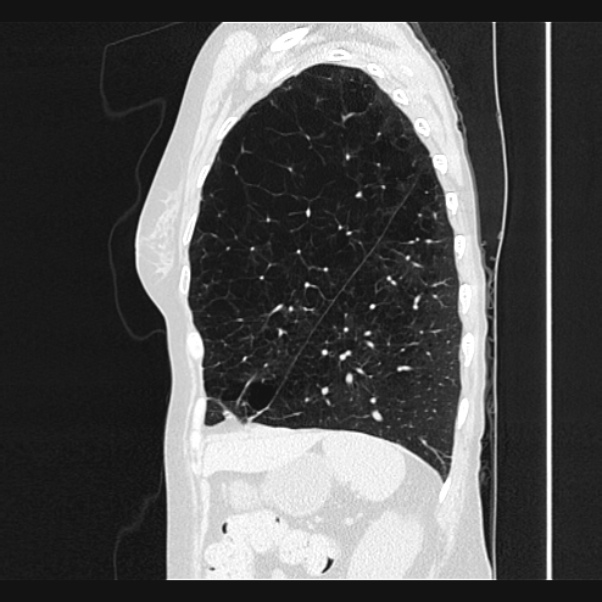 Centrilobular pulmonary emphysema (Radiopaedia 24495-24789 Sagittal lung window 66).jpg