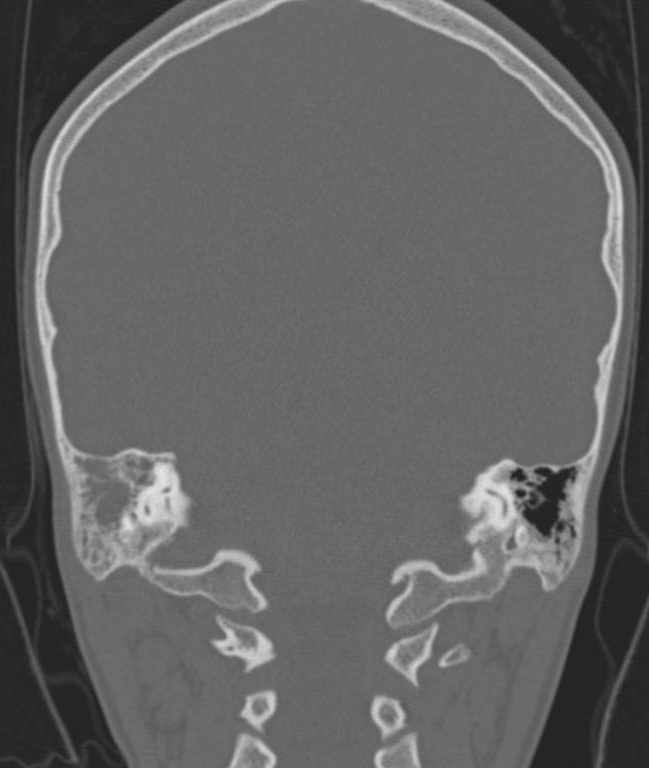 Cerebellar abscess (Radiopaedia 73727-84527 Coronal bone window 41).jpg