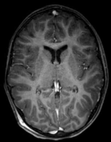 Cerebellar abscess (Radiopaedia 73727-84563 Axial T1 C+ fat sat 65).jpg