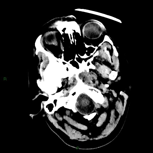Cerebellar abscess (Radiopaedia 78135-90671 Axial non-contrast 10).jpg