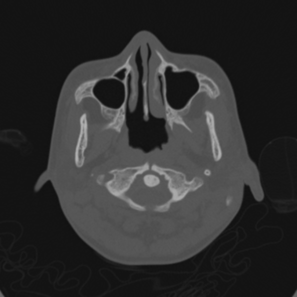Cerebellar abscess secondary to mastoiditis (Radiopaedia 26284-26413 Axial bone window 4).jpg