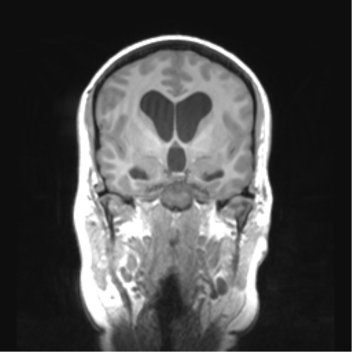 Cerebellar ependymoma complicated by post-operative subdural hematoma (Radiopaedia 83322-97736 Coronal T1 24).png