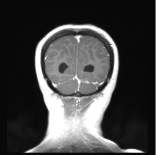 Cerebellar ependymoma complicated by post-operative subdural hematoma (Radiopaedia 83322-97736 Coronal T1 C+ 50).png