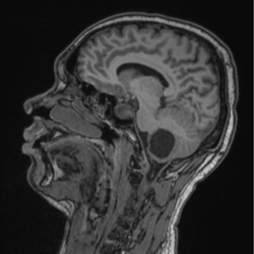 File:Cerebellar hemangioblastomas and pituitary adenoma (Radiopaedia 85490-101176 Sagittal T1 57).png