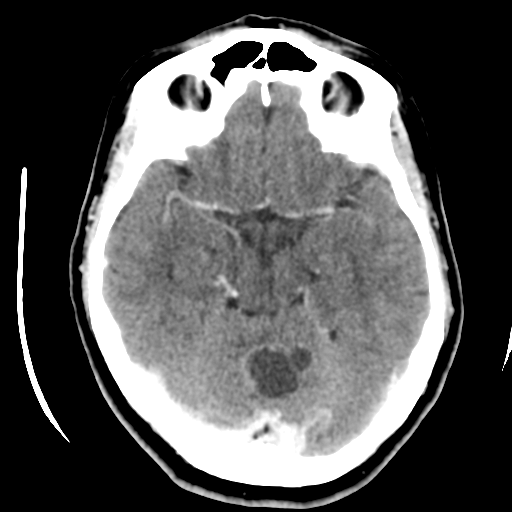 Cerebellar metastasis (cystic appearance) (Radiopaedia 41395-44258 B 20).png