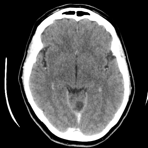 Cerebellar metastasis (cystic appearance) (Radiopaedia 41395-44258 B 23).png