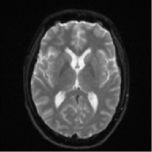 Cerebellar metastasis - adenocarcinoma lung (Radiopaedia 63184-71715 Axial DWI 16).png