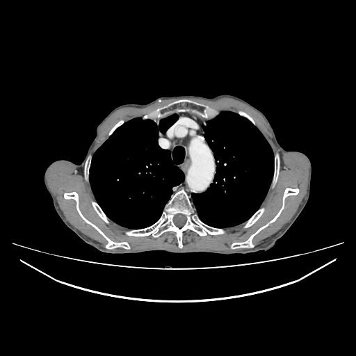 File:Cerebellar metastasis - lung tumor (Radiopaedia 69317-79150 A 8).jpg