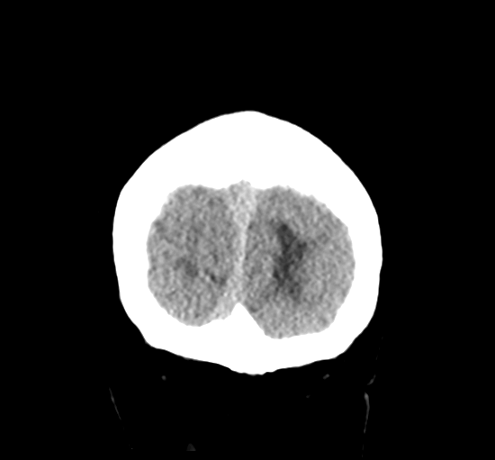 File:Cerebellar metastasis from lung adenocarcinoma (Radiopaedia 86690-102828 Coronal non-contrast 38).png