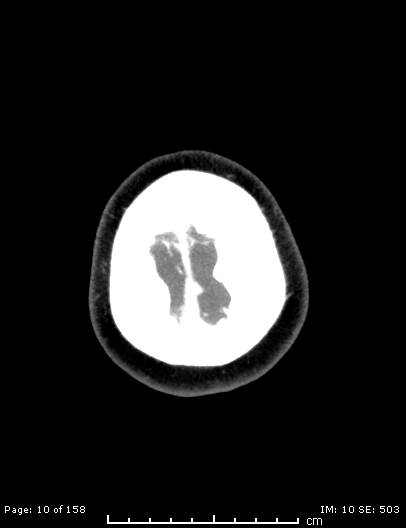 Cerebellar strokes due to intracranial giant cell arteritis (Radiopaedia 68799-78510 CT angiogram 10).jpg