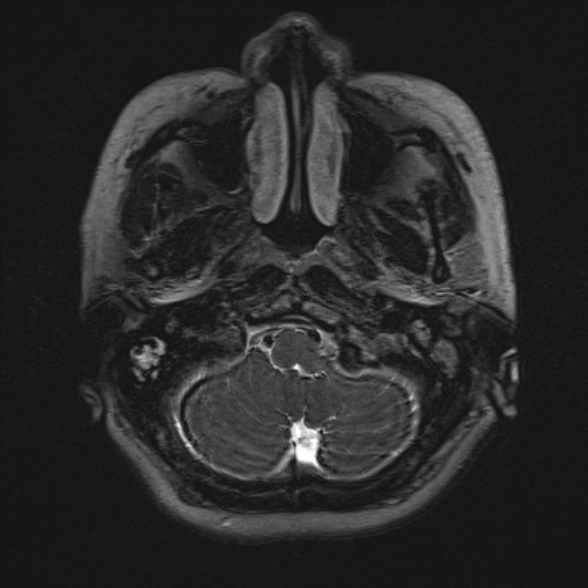 Cerebellopontine angle meningioma (Radiopaedia 53561-59591 Axial 3D volume T2 21).jpg