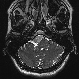 Cerebellopontine angle meningioma (Radiopaedia 72983-83680 Axial FIESTA 11).jpg
