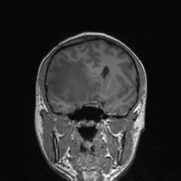 Cerebral abscess (Radiopaedia 24212-24478 Coronal T1 89).jpg