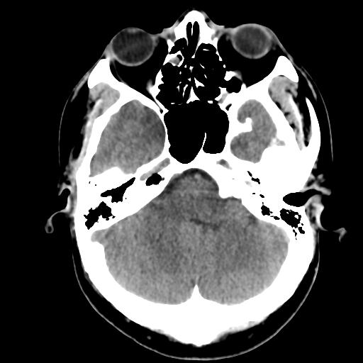 Cerebral abscess (Radiopaedia 29451-29919 Axial non-contrast 12).jpg