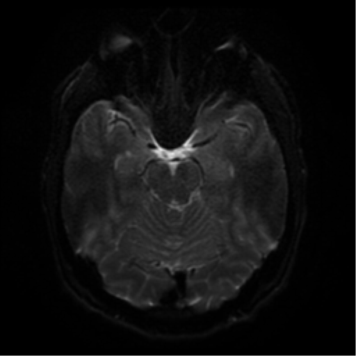 Cerebral abscess (Radiopaedia 57774-64740 Axial DWI 39).png