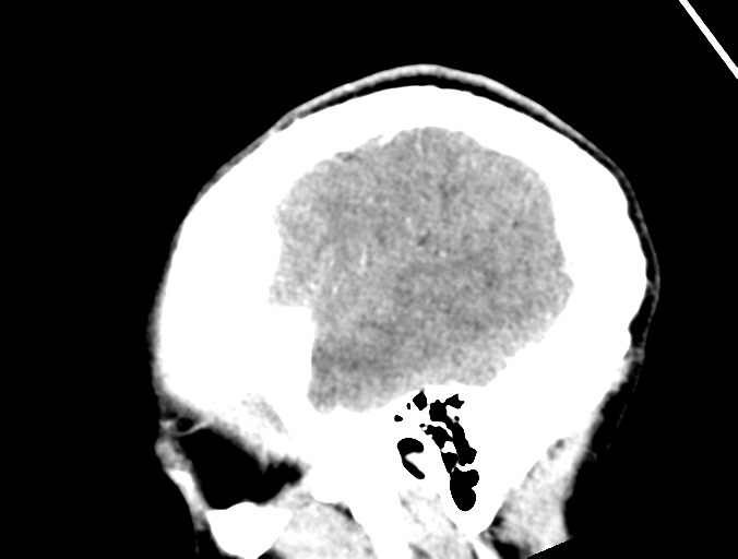 Cerebral abscess (Radiopaedia 60342-68008 Sagittal C+ delayed 8).png
