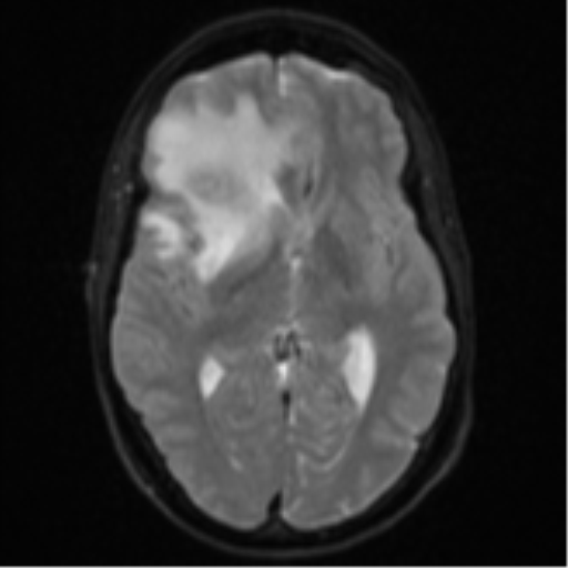 Cerebral abscess (Radiopaedia 60342-68009 Axial DWI 17).png