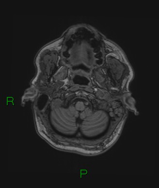 Cerebral abscess and subdural empyema (Radiopaedia 84436-99779 Axial T1 77).jpg