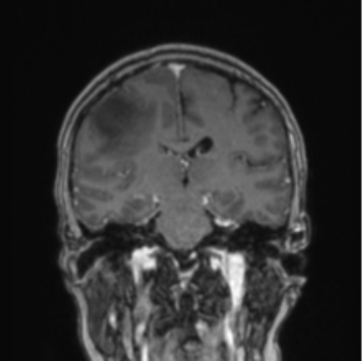Cerebral abscess from pulmonary arteriovenous malformation (Radiopaedia 86275-102291 L 42).png