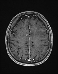 Cerebral amyloid angiopathy-related inflammation (Radiopaedia 58270-65377 Axial T1 C+ fat sat 105).jpg