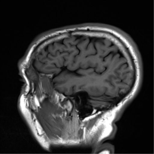File:Cerebral amyloid angiopathy (Radiopaedia 46082-50433 Sagittal T1 5).png