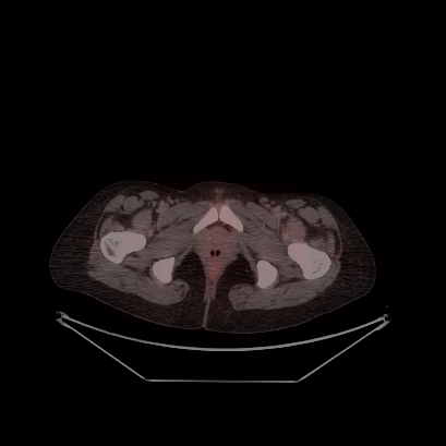 Cerebral and abdominal tuberculosis (Radiopaedia 90499-107853 C 243).jpg