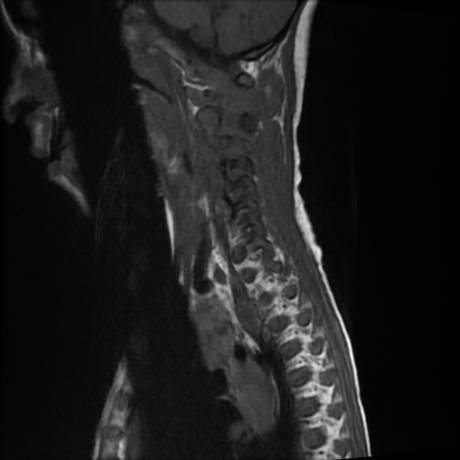 File:Cerebral and spinal tuberculosis (Radiopaedia 90489-107838 Sagittal T1 10).jpg