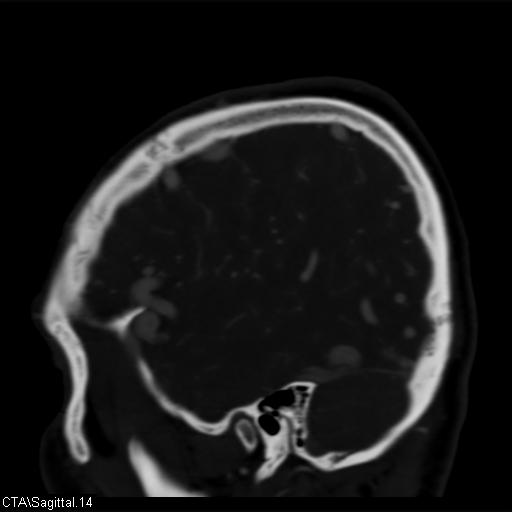 Cerebral arteriovenous malformation (Radiopaedia 28518-28759 D 11).jpg